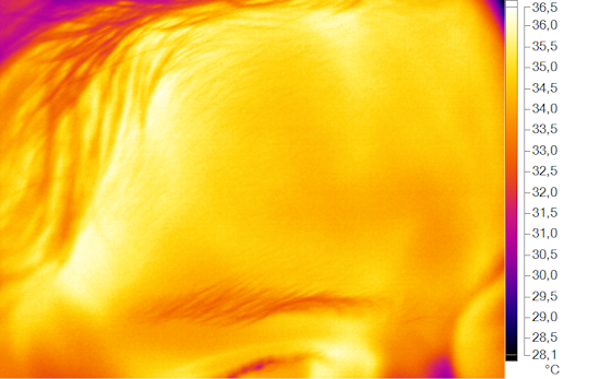 Thermal image of a forehead